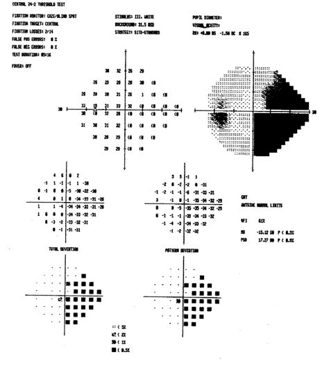 Visual Field Test: What It Is and What the Results Mean .